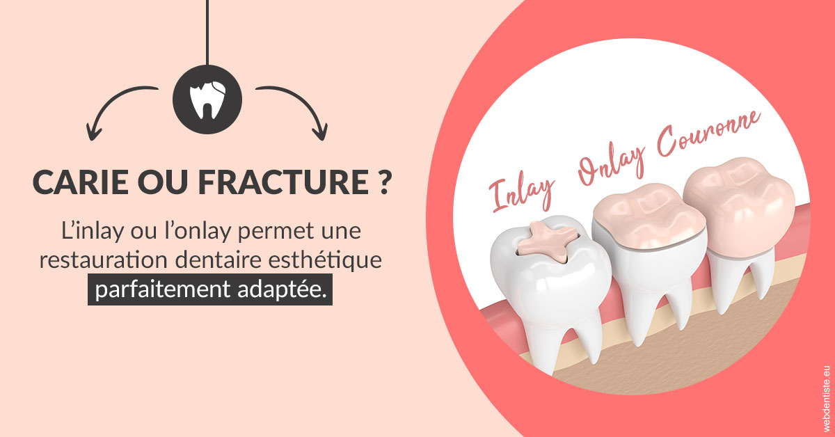https://dr-julien-buffet.chirurgiens-dentistes.fr/T2 2023 - Carie ou fracture 2