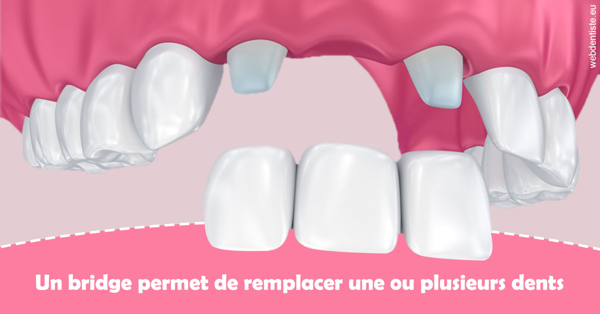 https://dr-julien-buffet.chirurgiens-dentistes.fr/Bridge remplacer dents 2