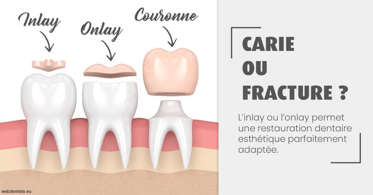 https://dr-julien-buffet.chirurgiens-dentistes.fr/T2 2023 - Carie ou fracture 1