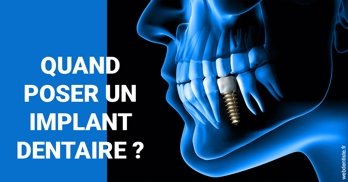 https://dr-julien-buffet.chirurgiens-dentistes.fr/Les implants 1