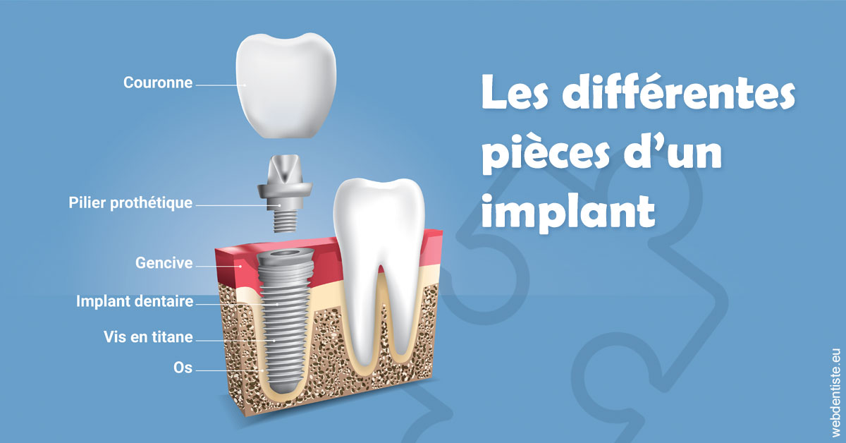 https://dr-julien-buffet.chirurgiens-dentistes.fr/Les différentes pièces d’un implant 1