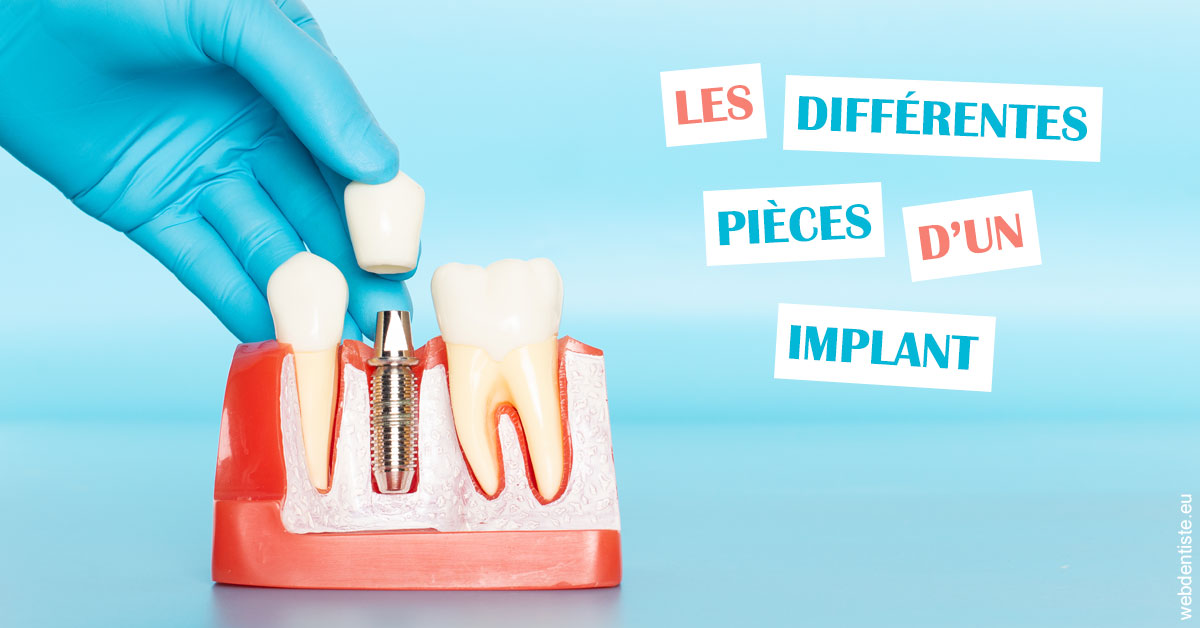 https://dr-julien-buffet.chirurgiens-dentistes.fr/Les différentes pièces d’un implant 2