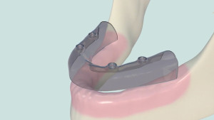 Appareil complet sur 4 implants avec boutons pressions
